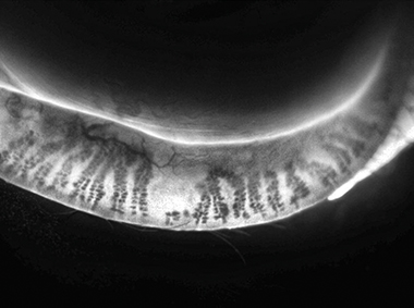 Vue des glandes de Meibomius sous illumination dynamique 